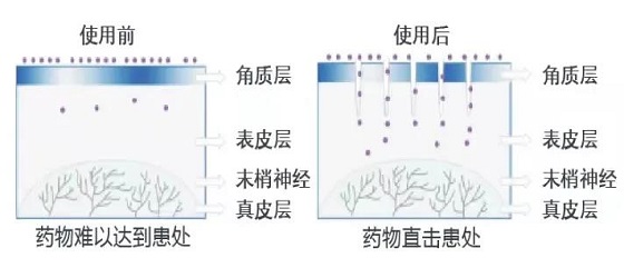 【脱发不可小觑 域发微针来啦】黄骅市人民医院皮肤科开展域发微针生发技术